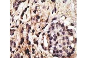 IHC analysis of FFPE human breast carcinoma tissue stained with the Beclin antibody