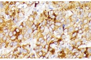 Immunohistochemistry of paraffin-embedded Human liver cancer using GALC Polyclonal Antibody at dilution of 1:100 (40x lens).