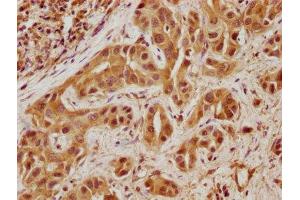 IHC image of ABIN7171764 diluted at 1:100 and staining in paraffin-embedded human liver cancer performed on a Leica BondTM system.