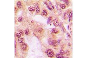 Immunohistochemical analysis of PSMC5 staining in human lung cancer formalin fixed paraffin embedded tissue section.