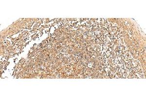 Immunohistochemistry of paraffin-embedded Human tonsil tissue using GRHPR Polyclonal Antibody at dilution of 1:35(x200) (GRHPR anticorps)
