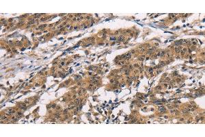 Immunohistochemistry of paraffin-embedded Human gasrtic cancer tissue using ADGRB1 Polyclonal Antibody at dilution 1:40 (ADGRB1 anticorps)
