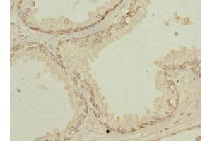 Immunohistochemistry of paraffin-embedded human prostate cancer using ABIN7154259 at dilution of 1:100 (NMT2 anticorps  (AA 1-120))