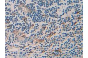 DAB staining on IHC-P; Samples: Human Prostate cancer Tissue (TNFRSF12A anticorps  (AA 24-126))
