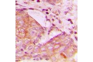Immunohistochemical analysis of TIM3 staining in human breast cancer formalin fixed paraffin embedded tissue section.