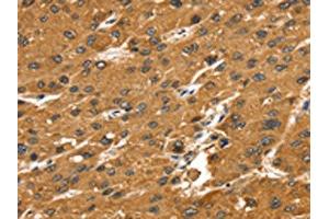 The image on the left is immunohistochemistry of paraffin-embedded Human liver cancer tissue using ABIN7192644(SRGAP1 Antibody) at dilution 1/25, on the right is treated with synthetic peptide. (SRGAP1 anticorps)