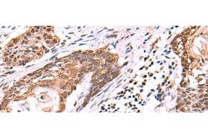 Immunohistochemistry of paraffin-embedded Human esophagus cancer tissue using KATNAL1 Polyclonal Antibody at dilution of 1:95(x200) (KATNAL1 anticorps)