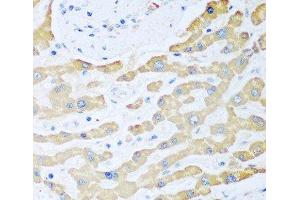 Immunohistochemistry of paraffin-embedded Human liver cancer using FDXR Polyclonal Antibody at dilution of 1:100 (40x lens). (Ferredoxin Reductase anticorps)