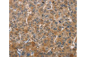 Immunohistochemistry of Human gastric cancer using TRIP4 Polyclonal Antibody at dilution of 1:40 (TRIP4 anticorps)