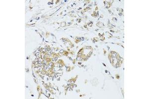 Immunohistochemistry of paraffin-embedded human gastric cancer using MAD2L2 antibody. (MAD2L2 anticorps  (AA 1-211))