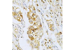 Immunohistochemistry of paraffin-embedded human gastric cancer using OLR1 Antibody (ABIN5970808) at dilution of 1/200 (40x lens). (OLR1 anticorps)