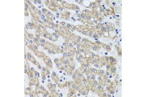Immunohistochemistry of paraffin-embedded human liver injury using ACP1 antibody (ABIN5975334) at dilution of 1/100 (40x lens). (ACP1 anticorps)