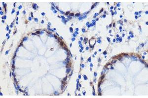 Immunohistochemistry of paraffin-embedded Human colon carcinoma using GCAT Polyclonal Antibody at dilution of 1:100 (40x lens). (GCAT anticorps)
