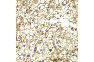 Immunohistochemistry of paraffin-embedded human kidney cancer using CD1D antibody at dilution of 1:200 (400x lens). (CD1d anticorps)