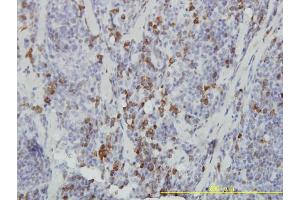 Immunoperoxidase of monoclonal antibody to ASB9 on formalin-fixed paraffin-embedded human lymphoma tissue. (ASB9 anticorps  (AA 1-252))