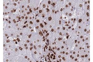 ABIN6267690 at 1/100 staining human Liver carcinoma tissue sections by IHC-P. (HDAC8 anticorps  (pSer39))