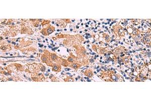 Immunohistochemistry of paraffin-embedded Human liver cancer tissue using IPPK Polyclonal Antibody at dilution of 1:30(x200) (IPPK anticorps)