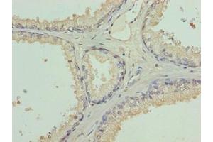 Immunohistochemistry of paraffin-embedded human prostate cancer using ABIN7158010 at dilution of 1:100