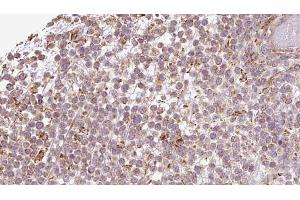 ABIN6273198 at 1/100 staining Human lymph cancer tissue by IHC-P. (ATP8A1 anticorps  (Internal Region))