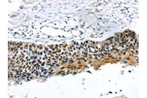 The image on the left is immunohistochemistry of paraffin-embedded Human esophagus cancer tissue using ABIN7192883(TRERF1 Antibody) at dilution 1/20, on the right is treated with synthetic peptide. (TRERF1 anticorps)