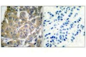Immunohistochemical analysis of paraffin-embedded human breast carcinoma tissue using Cox2 antibody. (PTGS2 anticorps)