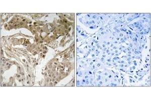 Immunohistochemistry analysis of paraffin-embedded human breast carcinoma, using FOS (Phospho-Thr232) Antibody.