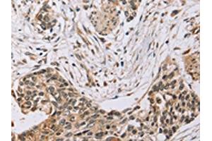 The image on the left is immunohistochemistry of paraffin-embedded Human esophagus cancer tissue using ABIN7130575(PDLIM7 Antibody) at dilution 1/35, on the right is treated with fusion protein.
