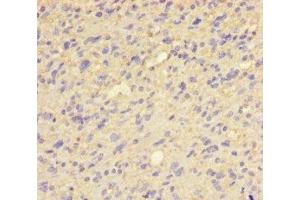 Immunohistochemistry of paraffin-embedded human glioma using ABIN7154027 at dilution of 1:100