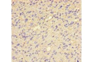 Immunohistochemistry of paraffin-embedded human glioma using ABIN7154027 at dilution of 1:100 (QPCT anticorps  (AA 29-361))