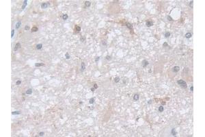 Detection of COTL1 in Human Glioma Tissue using Polyclonal Antibody to Coactosin Like Protein 1 (COTL1)