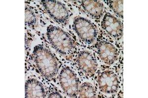 Immunohistochemical analysis of Tyrosyl-tRNA Synthetase staining in human colon cancer formalin fixed paraffin embedded tissue section.