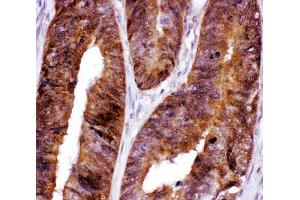 IHC-P: FOXO3A antibody testing of human intestinal cancer tissue (FOXO3 anticorps  (AA 471-673))