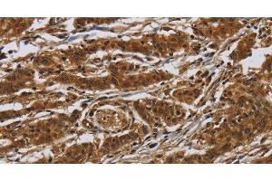 Immunohistochemistry of paraffin-embedded Human gasrtic cancer tissue using GATA5 Polyclonal Antibody at dilution 1:50 (GATA5 anticorps)