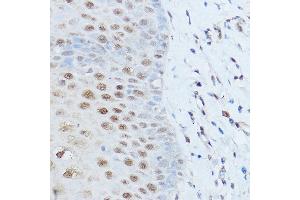 Immunohistochemistry of paraffin-embedded human esophageal cancer using SM antibody (ABIN6128718, ABIN6148113, ABIN6148114 and ABIN6215679) at dilution of 1:100 (40x lens). (SMARCD2 anticorps  (AA 454-531))