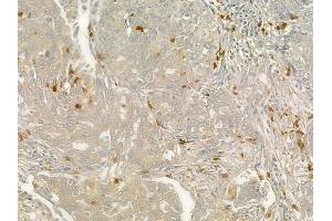 ABIN6260736 and ABIN6276827 at 1/100 staining human lung squamous cell carcinoma by IHC-P. (CEACAM1 anticorps  (C-Term))