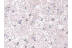 Detection of ARPC2 in Human Glioma Tissue using Polyclonal Antibody to Actin Related Protein 2/3 Complex Subunit 2 (ARPC2)