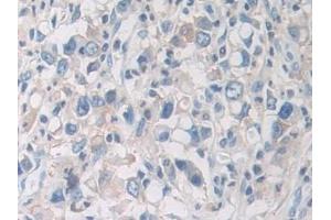 Detection of PYGB in Human Stomach cancer Tissue using Polyclonal Antibody to Glycogen Phosphorylase, Brain (PYGB)