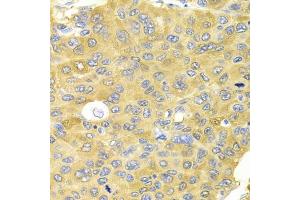 Immunohistochemistry of paraffin-embedded human liver cancer using PA2G4 Antibody (ABIN5973112) at dilution of 1/100 (40x lens). (PA2G4 anticorps)