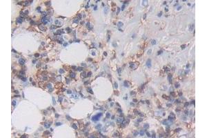 Detection of MHCC in Human Skin cancer Tissue using Polyclonal Antibody to Major Histocompatibility Complex Class I C (MHCC) (MHCC (AA 48-305) anticorps)