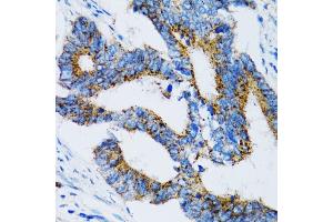 Immunohistochemistry of paraffin-embedded human colon carcinoma using SI antibody (ABIN3016131, ABIN3016132, ABIN3016133 and ABIN6219568) at dilution of 1:100 (40x lens).