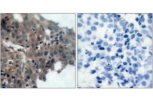 Immunohistochemistry analysis of paraffin-embedded human breast carcinoma, using p21 Cip1 (Phospho-Thr145) Antibody. (p21 anticorps  (pThr145))