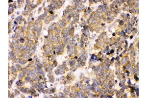 Anti- PDPK1 Picoband antibody, IHC(P) IHC(P): Human Lung Cancer Tissue
