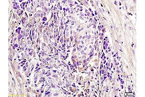 Formalin-fixed and paraffin embedded human laryngocarcinoma labeled with Anti CD336 NKp44 NCR2 Polyclonal Antibody, unconjugated (ABIN740010) at 1:400 followed by incubation with conjugated secondary antibody and DAB staining.