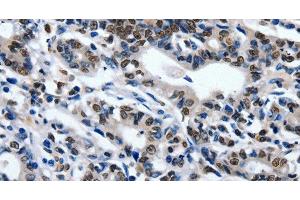 Immunohistochemistry of paraffin-embedded Human gasrtic cancer tissue using CD203c Polyclonal Antibody at dilution 1:80 (ENPP3 anticorps)