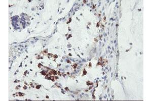 Immunohistochemical staining of paraffin-embedded Adenocarcinoma of Human colon tissue using anti-SDS mouse monoclonal antibody. (serine Dehydratase anticorps)