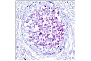 Immunohistochemical analysis of paraffin-embedded human breast carcinoma tissue using Raf1(Phospho-Ser259) Antibody. (RAF1 anticorps  (pSer259))