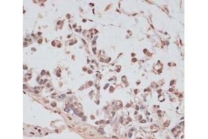 Immunohistochemistry of paraffin-embedded Human gastric cancer using PRPF31 Polyclonal Antibody at dilution of 1:100 (40x lens). (PRPF31 anticorps)