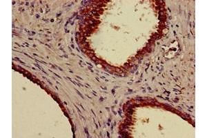 Immunohistochemistry of paraffin-embedded human prostate cancer using ABIN7157393 at dilution of 1:100