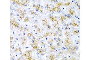 Immunohistochemistry of paraffin-embedded Human liver damage using WNT2 Polyclonal Antibody at dilution of 1:200 (40x lens). (WNT2 anticorps)