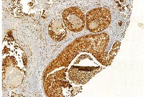 ABIN6264959 and ABIN6272887 at 1/100 staining Human breast cancer by IHC-P. (EXOC2 anticorps  (N-Term))